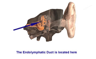 Endolymphatic Duckshot